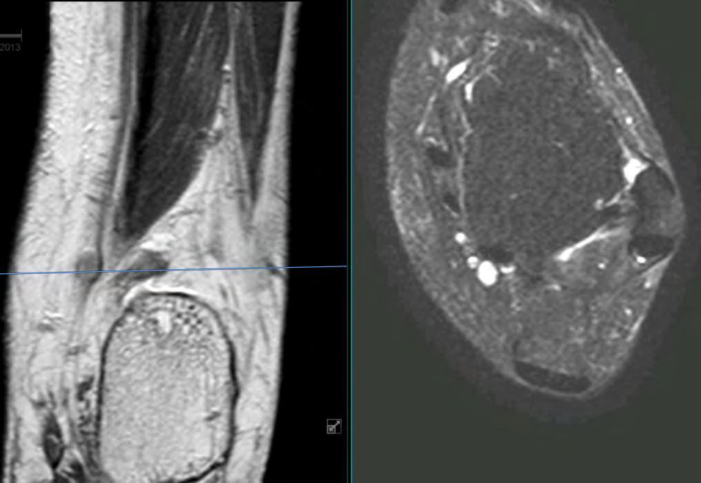 Röntgen (AP, LAT) CT/MRI Echo EMG