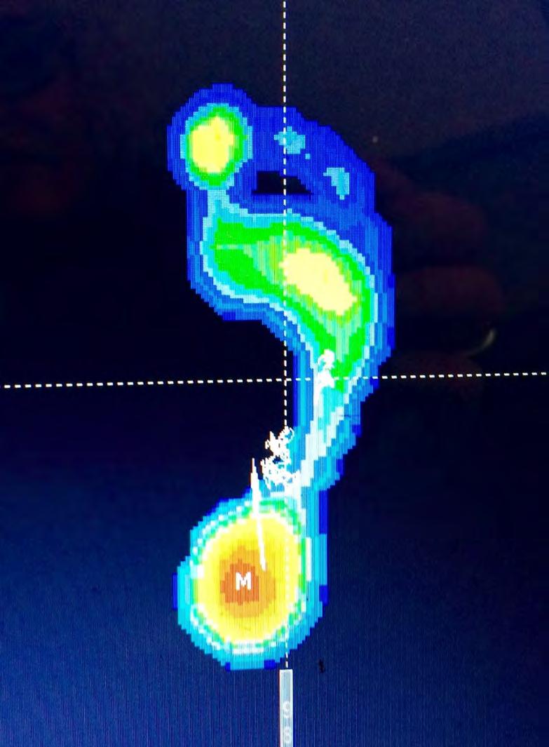 Functionele hallux