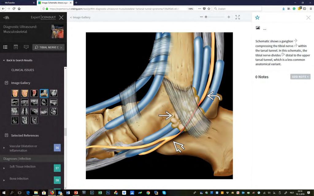 Tarsale tunnel syndroom -anatomie- 3 2 1 TN retinaculum cyst 1.