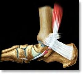 Tibialis posterior dysfunctie - multifactoriële etiologie - Vasculair Hypovasculaire zone