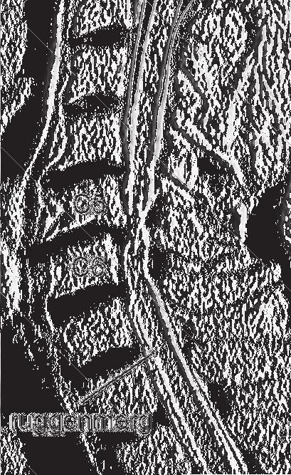 1p 4 De afbeelding hieronder is een MRI-scan van een deel van de hals van een patiënt met een vernauwing van het halswervelkanaal.