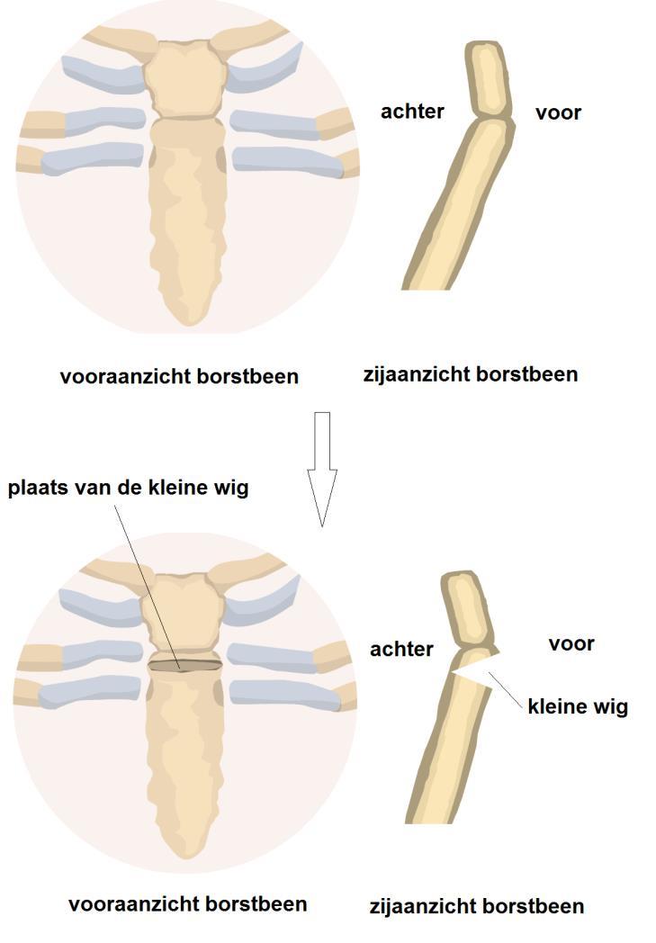 Daardoor komt het borstbeen voor een groot deel los te liggen en laat het zich gemakkelijker vervormen. Het borstbeen wordt recht gebogen nadat er een klein driehoekje (wig) is weggehaald.