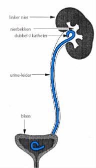 De uroloog heeft besloten bij u een dubbel-j-katheter te plaatsen. Dit is een katheter die geplaatst wordt in de urineleider tussen de nier en de blaas.