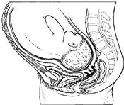 PATIËNTENINFORMATIE 3. Wanneer is een inleiding mogelijk Een inleiding is pas mogelijk als de baarmoedermond al een beetje open en verweekt is.