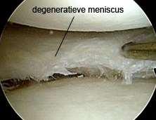 Ontwikkeling Behandeling Meniscus scheur 1897: Open totale meniscectomie 1948: Gevolg: vroege artrose 1960: artroscopische partiele meniscectomie Gevolg: nog steeds, maar in trager tempo: vervroegde