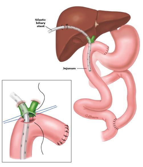 3.6.2.1. Hepaticojejunostomie De Roux-en-Y hepaticojejunostomie (HJ) is de biliodigestieve anastomose die het beste resultaat geeft (figuur 3). Het is de meest gebruikte en veiligste methode.