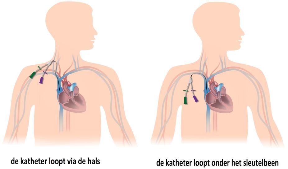 De katheter bestaat uit meerdere delen Als de katheter is ingebracht, zit er een gedeelte onder uw huid in een bloedvat en een gedeelte aan de buitenkant van uw lichaam.