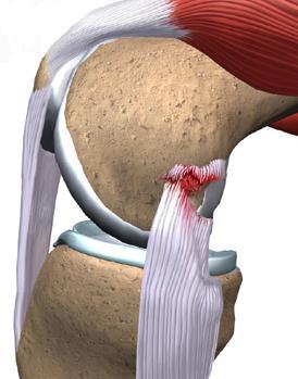 Collateraal bandletsel Vrijwel altijd mediaal bandletsel, zelden lateraal S Pijn en zwelling aan mediale of laterale zijde knie