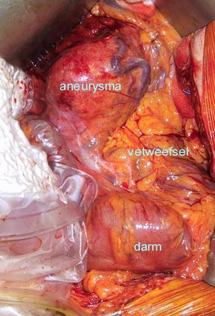 De behandeling van een aneurysma van de buikslagader Als een aneurysma van de buikslagader is vastgesteld dan kan een operatie worden overwogen.