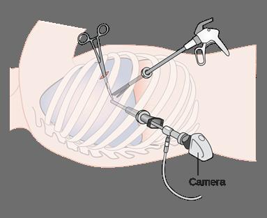 Wat gebeurt er tijdens een VATS lobectomie of segmentectomie? VATS staat voor video assisted thoracic surgery en betekent eigenlijk dat de ingreep via een kijkoperatie wordt uitgevoerd.