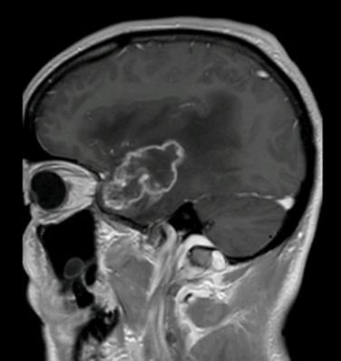 Neuro-oncologische