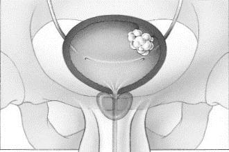 Een druiventros -of poliepvormig gezwelletje dat met een dun steeltje verbonden is aan de blaaswand. Vaak is dit het geval bij een oppervlakkig groeiende tumor.