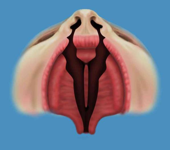 Tussenkaak Figuur 5. Dubbelzijdige lip-kaak-gehemeltespleet Figuur 6a. Situatie voor de tussenkaakcorrectie Figuur 6b.