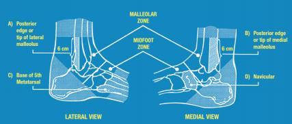Ottawa Ankle Rules (OAR) betrouwbaar instrument om ossale pathologie uit te