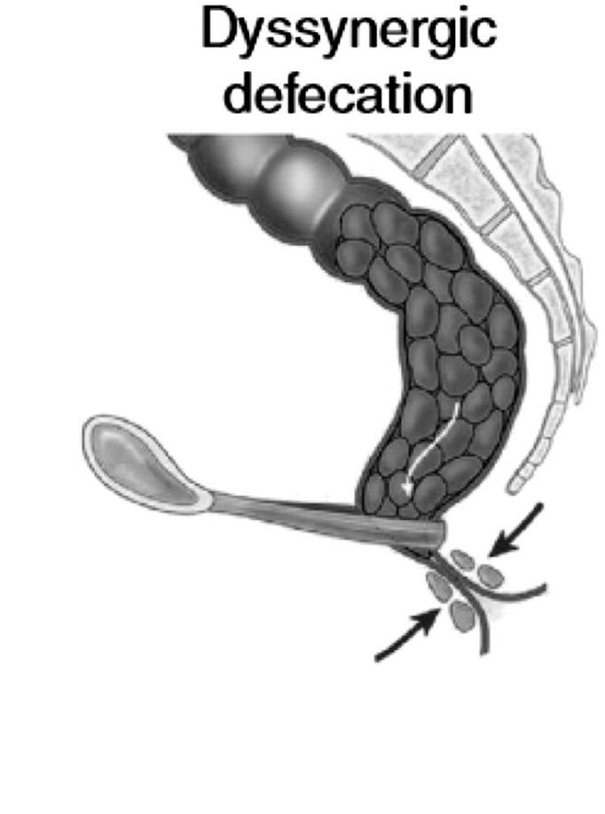 During repeated attempts to defecate, there must be features of impaired evacuation, as demonstrated by 2 of the