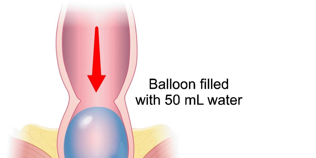 Technische onderzoeken Ballon expulsie test Met water gevulde ballon in rectum In zittende positie Normaal indien <5min Defecografie Prolaps, rectocoele straling