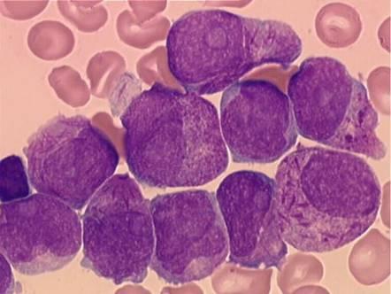 Acute promyelocyten leukemie (APL, vroeger AML-M3) Vroege mortaliteit door bloedingen (DIS) Ziekte ten gevolge