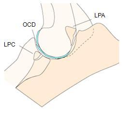 2. ELLEBOOGDYSPLASIE Een losse processus anconeus maakt, naast een losse processus coronoïdeus en osteochondrosis dissecans van het mediale aspect van de humeruscondyl, deel uit van het