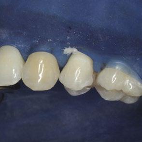 01 Behandeling van overgevoelig cervicaal dentine met GLUMA Desensitizer / GLUMA Desensitizer PowerGel 1.