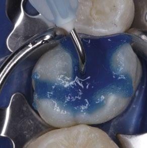Appliceer GLUMA Desensitizer op de dentine gedurende 30-60 sec.