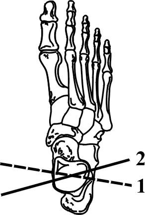 De as zou dan in de rechter voet in een bovenaanzicht van dorsaal-mediaal naar ventraal-lateraal moeten lopen (figuur 11, aspositie 2).