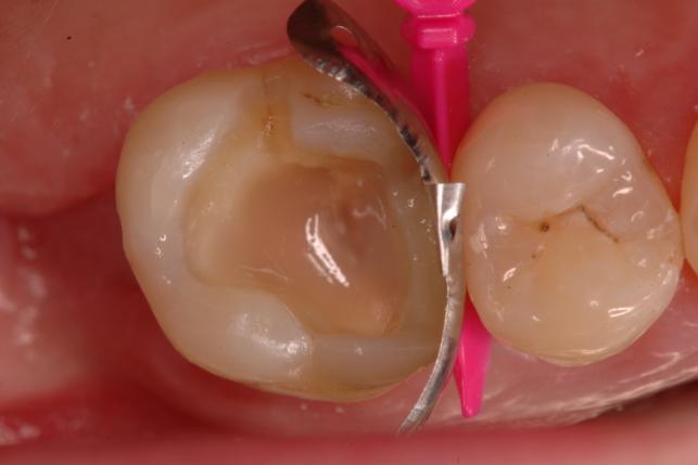 Praktijkvoorbeeld 2 De eerste molaar rechtsboven bij een patiënt van 44 jaar moet na een wortelkanaalbehandeling, geïndiceerd door de aanwezigheid van cariës, thans stabiel worden gerestaureerd.
