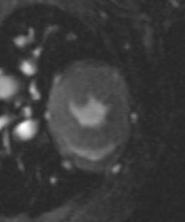 End-systolic End-diastolic 80 60 40 WT 40 20 20 0 WT HET HOM 0 WT HET HOM HOM Ejection fraction