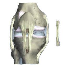 Uw orthopedisch chirurg heeft geadviseerd om de voorste kruisband van uw knie te vervangen en daarmee de stabiliteit van de knie te verbeteren.