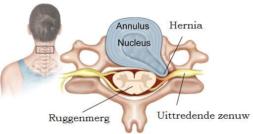 Inleiding Deze brochure biedt u de nodige informatie over de heelkundige behandeling van een cervicale hernia via anterieure cervicale discectomie (ACIF).