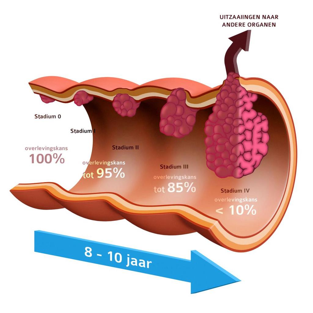 1.4 Hoe ontstaat dikkedarmkanker Verschillende stadia Stadium 0: poliep, enkel in binnenste slijmvlies (nog geen DDK) Stadium I: al in wand van dikkedarm Stadium