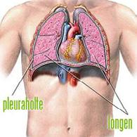 Wat is een pneumothorax (klaplong)? Een pneumothorax wordt ook wel een klaplong genoemd. De longen zijn omgeven door twee vliezen (pleurabladen).