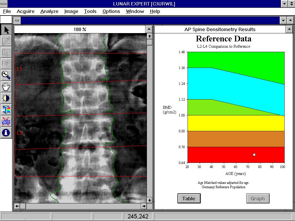 Densitometrie wervelkolom (voorachterwaartse opname) Referentiegegevens L2-L4 Vergelijking met