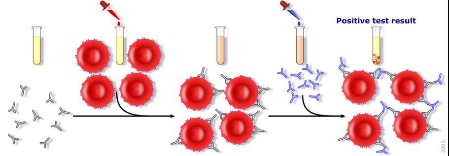 RBC alloimmunisatie: diagnostiek Indirecte antiglobuline test: (niet-gebonden) antistoffen in serum?