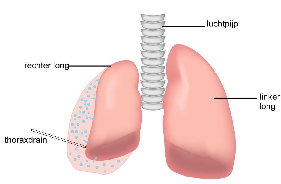 De thoraxdrain: door het onderzoek komt er lucht tussen de borstkas en de long waardoor de long iets inklapt De thoraxdrain wordt aangesloten op een