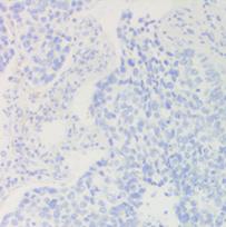 CME Academy Immunotherapie en PD-L1-expressie bij niet-kleincellig longcarcinoom Er is gebleken dat bij longkanker de PD-L1-expressie op de