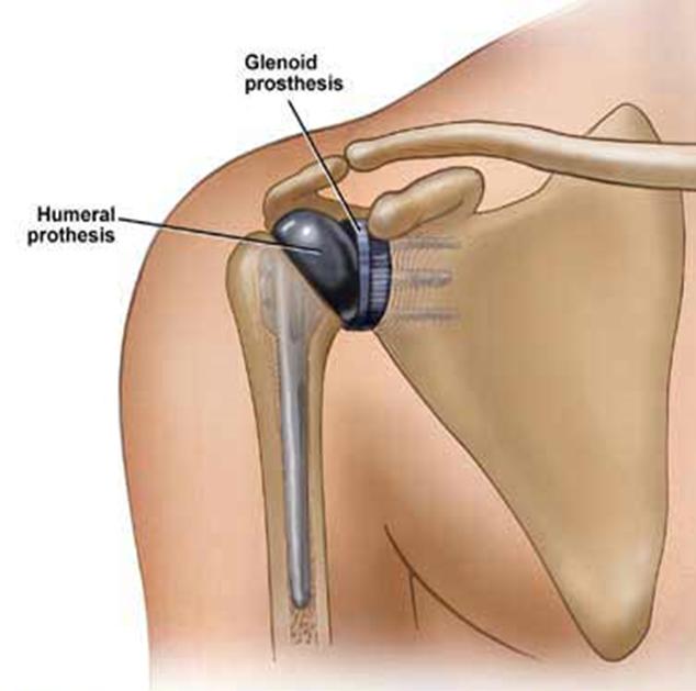 Waarom een schouderprothese? Slijtage van het kraakbeen is de meest voorkomende reden voor de operatie.