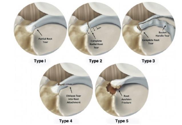 Meniscal root lesions Root letsels: - radiaire scheur of avulsie van de posterieure hoorn - prevalentie 8%