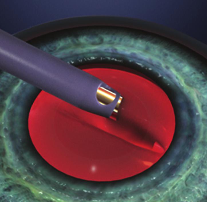 Tijdens de operatie wordt de troebele lens opgezogen en een helder nieuw lensje door een 2,5 mm klein openingetje in het oog gebracht.