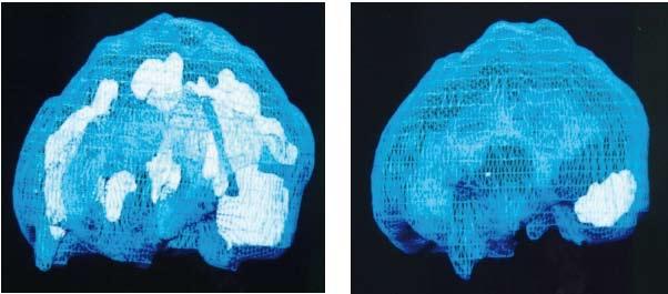 Hersenscans voor en na EMDR van een vrouw met PTSS. De witte gebieden geven overactiviteit in de hersenen aan. Figuur 1.
