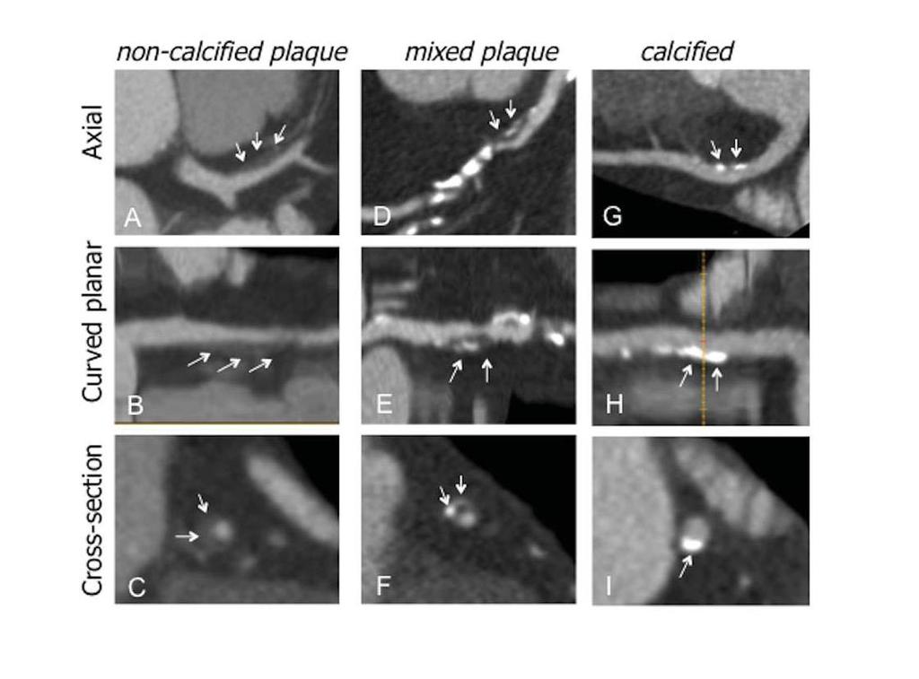 Evaluation of coronary plaque 150 RA patients vs 150 controls 64 slice CT angiography Plaques Number &