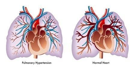 Pulmonale arteriële hypertensie 7% van de patiënten met een (gesloten)