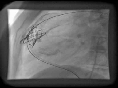 Pulmonalisklep vervanging Voor de procedure Na