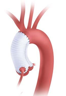 Ontwikkelingen aorta