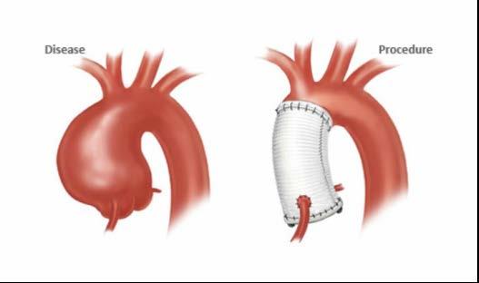 External Aortic Root Support