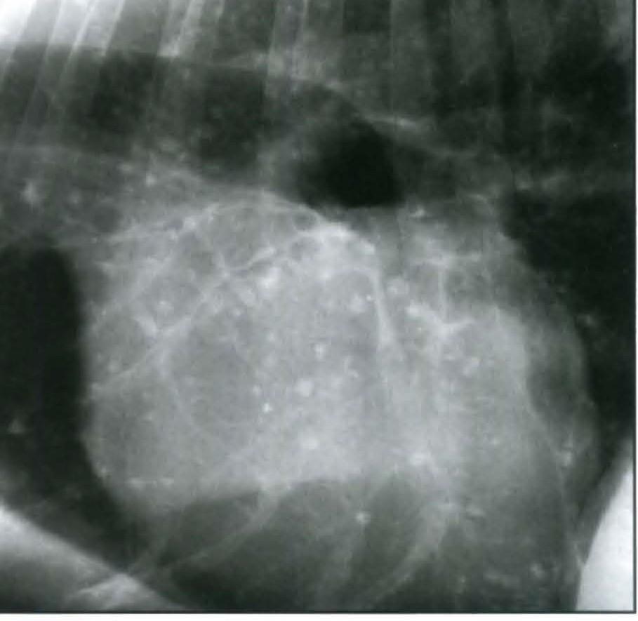 Pulmonary Osteoma's / Pleural plaques (Fig.