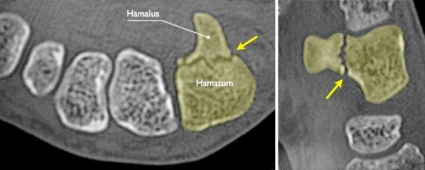 Golf Hamulus fractuur - Diagnose (RX) CT of MRI -