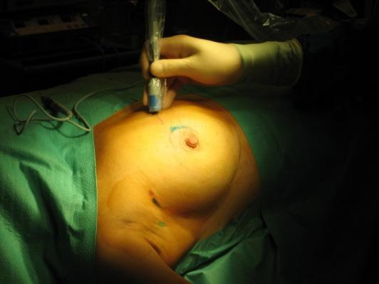 Chirurgische procedure Techniek: