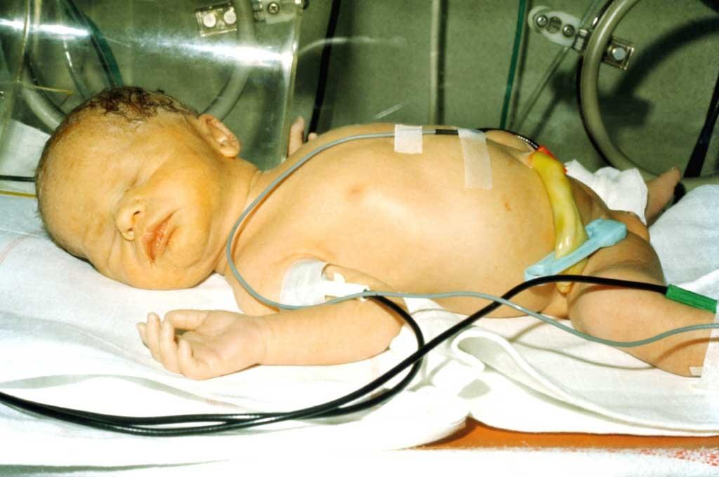 Hemolytische ziekte van de foetus en pasgeborene (HZFP) HZFP: