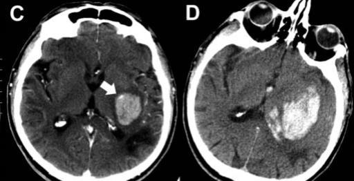 CT angiography "spot sign" predicts