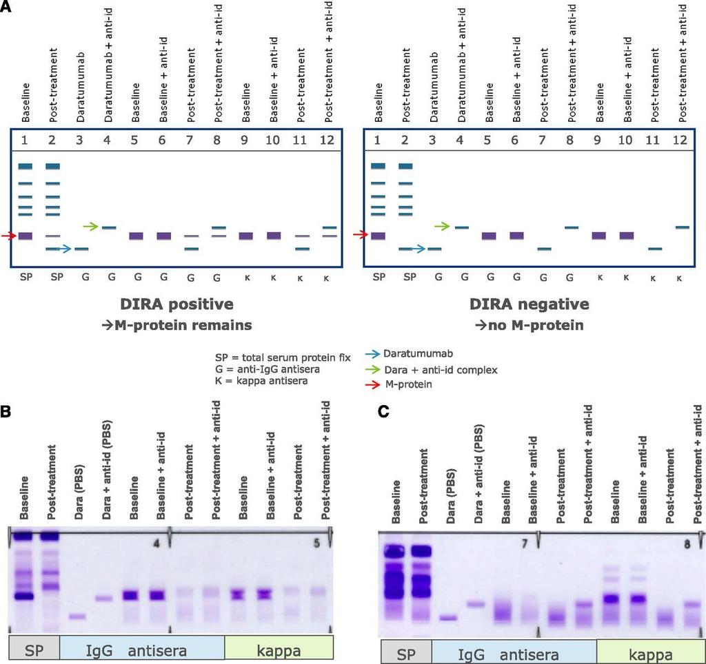 Management of interference of daratumumab with SPEP and IFE assays by using DIRA.